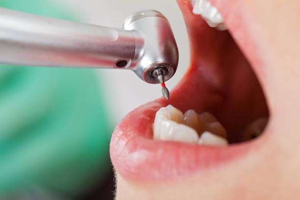 Best Knocked-Out Tooth Emergency  in Lely, FL